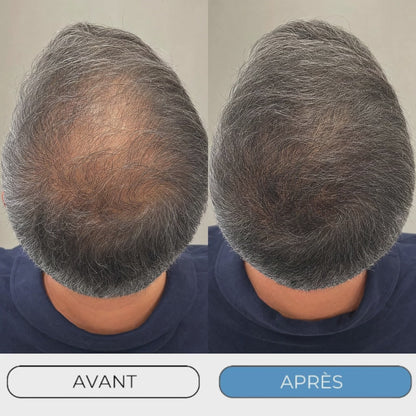 Technologie Capillaire Micro-infuse Homme